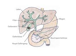 Gallensteine können bis zu mehrere zentimeter groß werden. Gallensteine