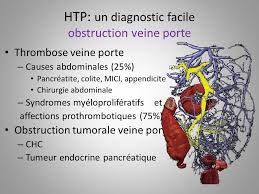 Hypertension Portale De Cause Indeterminee Ppt Telecharger
