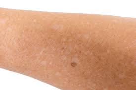 Sometimes the white spots are merely scars that have become more visible after tanning. White Spots On Skin From Sun Exposure How To Prevent Treat