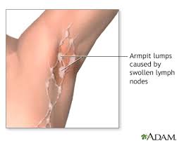 Ingrown hairs are capable of developing under skin on any area of your body, especially the face and legs, but they can be particularly annoying when they plant themselves in your armpit. Armpit Lump Information Mount Sinai New York
