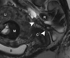 They are readily diagnosed on ultrasound, with most demonstrating classical radiographic features. Endometriosis Mri Lexicon Consensus Statement From The Society Of Abdominal Radiology Endometriosis Disease Focused Panel Springerlink