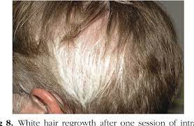 I lost pretty much 85% of my hair, it took quite a while before it started slowly filling in, very slow at first, all white. Figure 8 From Alopecia Areata Update Semantic Scholar