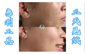 痘痘先生獨門專利技術清粉刺痘痘/做臉- 專利工具｜專利技術｜三天見效#閉鎖性粉刺#內包#內包毛#開放性粉刺#黑頭粉刺#