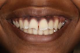 Image result for Tooth Fracture