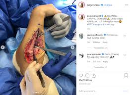 After suffering a submission loss to michelle waterson over a year ago, 12 gauge opted to take an extended break from the fight that said, two straight losses isn't the end of the world for vanzant — as the broken arm defintely played a huge part in the outcome of the fight — she. Paige Vanzant Shares Graphic Images Of Arm During And After Surgery Unilad