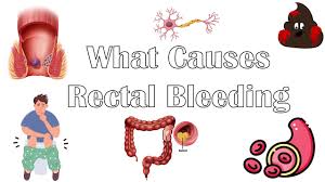 Image result for blood in stool human poop