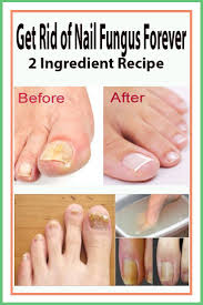 Get Rid Of Nail Fungus Forever 2 Ingredient Recipe Toenails Care Toe Fungus Remedies Toe Fungus Nail Fungus