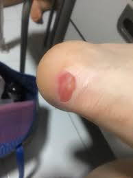 Help I Have A Huge Blister And I Have Taped It With A Blister Plaster But It Still Hurts When I Wear My Pointe Shoes Cos The Shoe Is Pressing On The