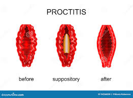 Image result for Proctitis