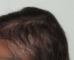 Ai 20 anni è soggetto ad una precoce (o precocissima) perdita dei capelli. La Caduta Dei Capelli Negli Adolescenti Cause E Sintomi