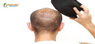 Both male and female pattern baldness is genetic. Does Continuous Wearing Of Caps Cause Hair Fall