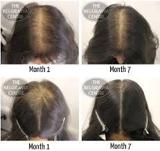 Early treatment may slow or reverse hair many people wonder what's the best treatment for hair loss in women? Women S Hair Loss Treatment Success Stories