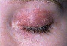 Natural Solution For Peeling Itchy Eyelid Http Www Healthboards Com Boards Rosacea 721574 Itchy Swollen Red Dry Skin Dry Skin Around Eyes Flaky Skin On Face