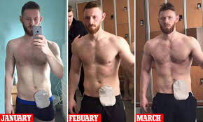 Man With Crohns Disease Takes Gym Selfies Showing His
