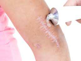 Boxcar scars can, in most cases, be treated. Getting Rid Of Old Scars Best Home Remedies