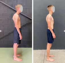 Image result for Winged Scapula