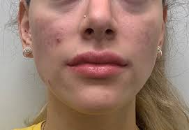 Image result for red rash face