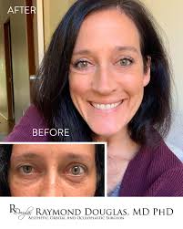 Before & after bilateral Orbital Decompression surgery 👁👁 These results  were achieved in a single surgery where I moved the eyes back 3+mms to  restore her pre-TED appearance. She is now fully