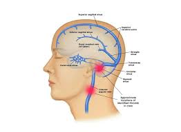 Risk of Venous Thromboembolism During Spaceflight