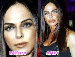 All About Michaela Romanini—Plastic Surgery Nightmare - HubPages