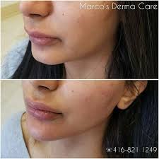 Learn more about how pearlman aesthetic surgery in new york city can help you. Non Surgical Jaw Line Contouring Mini Chin Enhancement Mid And Lower Face Lift Nonsurgicallaughlinesenhanceme Facial Contouring Face Fillers Facial Fillers