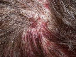 Wie Zu Behandeln Scalp Sores Youtube Pickel Auf Der Kopfhaut Mittel Gegen Haarausfall Frisuren Bei Haarausfall