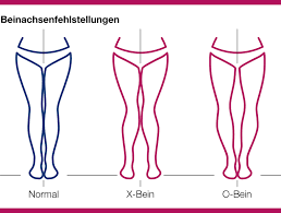 Gelenkschmerzen Durch Fehlstellungen Die Haltung Bewahren
