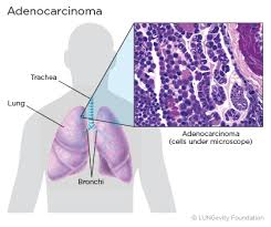 Learn more about what the stages of lung cancers mean. Lung Adenocarcinoma Lungevity Foundation