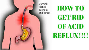 How to get rid of heartburn naturally and fast? How To Get Rid Of Acid Reflux Or Heartburn Fast With Proven Method Youtube