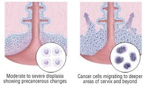 Because you have a history of cervical cancer, you will likely need to continue having. Cervical Cancer Causes Symptoms Treatment Options Drugs Com