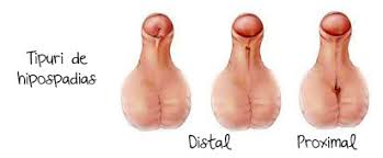 Halk arasında doğuştan sünnetli olmak, peygamber sünnetli veya yarım sünnetli anlamına gelen hipospadias, farklı tiplerde. Hipospadias La Copil Desprecopii Com