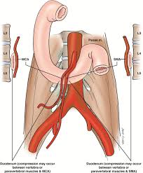 Keith Siau On Twitter The Superior Mesenteric Artery Sma Can Result In 2 Compression Syndromes Meded 1 Sma Syndrome Duodenal D3 Compression 2 Nutcracker Syndrome Renal Vein Compression Https T Co Utnxcf0ay4 Https T Co 4u8qlayav3