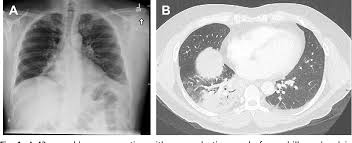 Legionella pneumonia is a lung infection caused by legionella pneumophila. Figure 1 From Thoracic Imaging Features Of Legionnaire S Disease Semantic Scholar