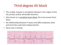 Maybe you would like to learn more about one of these? 3rd Degree Third Degree Heart Block Ecg