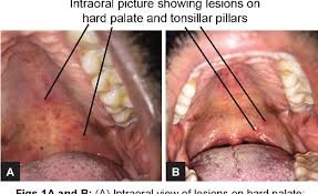 Image result for Hand foot and mouth disease HFMD roof of mouth