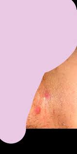The herpes simplex virus (hsv) can be broken down into two different types. Help Is This Herpes Genital Herpes Simplex Forums Patient