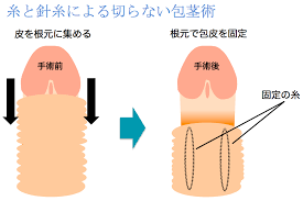泌尿器科の専門医が徹底解説】包茎手術・全８種類の手術方法
