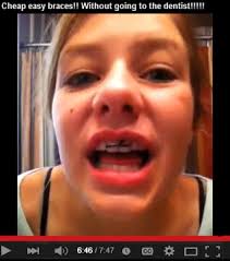 Fake braces may make you look fashionable but at the same time they can make your teeth mobile and cause other oral health issues. Fake Braces Life Hack Or Life Threatening Your Smile Dental Care