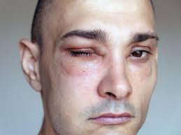 Kenali 5 Jenis Alergi yang Umum Terjadi di Kulit