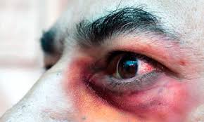 La combinación de golpes que es el tercer país en superar los 300 mil muertos por covid; Murio En Ciudad De Mexico Caso Sospechoso De Hongo Negro