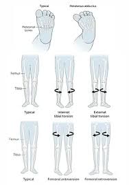 Image result for In-Toeing