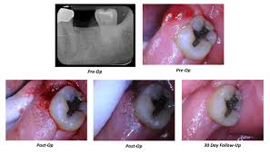 Image result for Periodontal Abscess