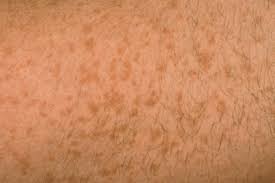 Purpura are purple or red spots on the skin or mucus membranes. Case Study A Transient Purpuric Rash With Vomiting Gponline