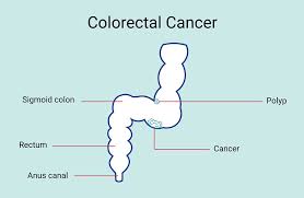 Image result for Colorectal Cancer