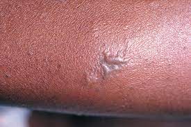 In females, gonorrhea can also infect the cervix. Gonorrhea Wikipedia