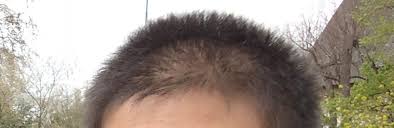 In most cases it is vertex and front.temples which goes first. Asian Hair Loss Body Hair Loss Hairlosstalk Forums