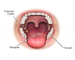 But you should take both of them seriously. Odontovida Oral Cancer