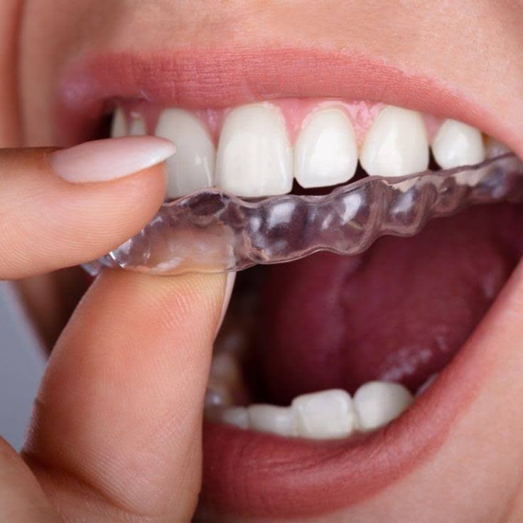 Invisalign Aligners For Over Bite product image
