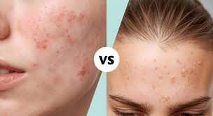 Hormonal Acne vs. Fungal Acne: How to ...