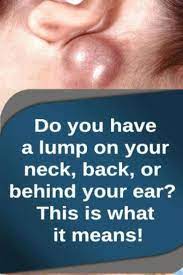 Do You Could Have A Lump In Your Neck Back Or Behind Your Ear That Is What It Means Lumponthighunderskin Lump Behind Ear Skin Bumps Neck